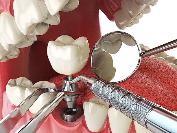 Best Emergency Dental Care for Broken or Chipped Teeth in Petersburg, IL